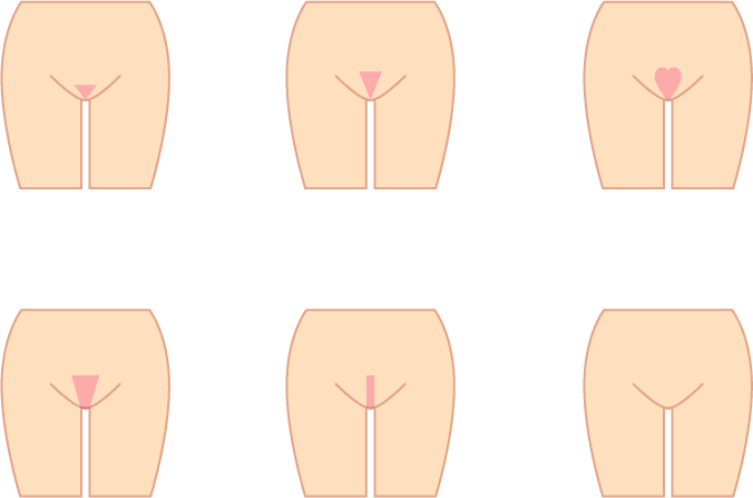 VIOの形 6パターン